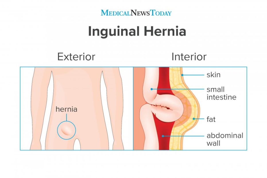 Inguinal Hernia: Surgery, Symptoms, And Causes